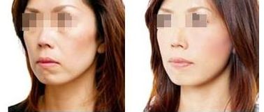 2024珠海雙眼皮手術(shù)醫(yī)院推薦，幫您預(yù)測前五家