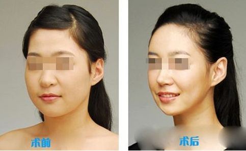 肌功能矯治，哪個(gè)階段適合兒童早期干預(yù)？哪些醫(yī)院堪稱專家？