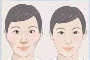 雙眼皮術后護理全攻略：埋線和全切有何異同？多久恢復自然？