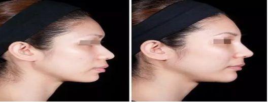 廣州哪家整形醫(yī)院祛痘效果比較好？去痘患者首選醫(yī)院排行榜