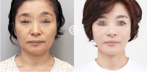 蘇州奧克拉醫(yī)院的整形效果及評(píng)價(jià)如何？