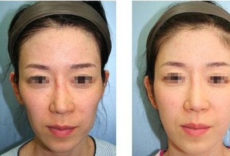 沈陽鼻整形醫(yī)院排名前5，專家推薦！