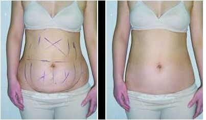 浙江哪家醫(yī)院做吸脂好？TOP10醫(yī)院推薦