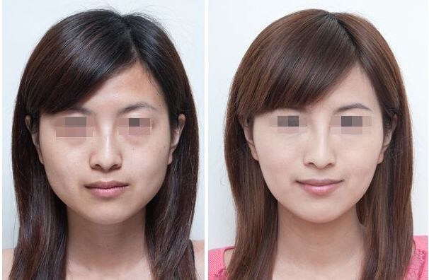 合肥哪家雙眼皮修復(fù)效果好？排名前十的整形醫(yī)院大揭秘