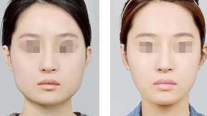 濟南市優(yōu)質(zhì)隆鼻醫(yī)院排行榜一覽