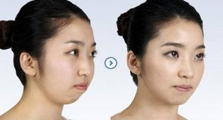 無錫哪家醫(yī)院胸部整形效果好