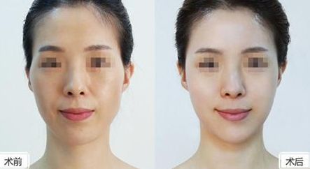 上海割雙眼皮哪家好？佀同帥醫(yī)生實(shí)力卓越，口碑實(shí)證