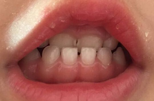 淄博哪里做雙眼皮好又靠譜？手術(shù)費用大概是多少呢？詳細(xì)了解！