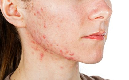 廣州常春藤眼科近視眼矯正：微創(chuàng)全飛秒，15800元起，快速恢復(fù)