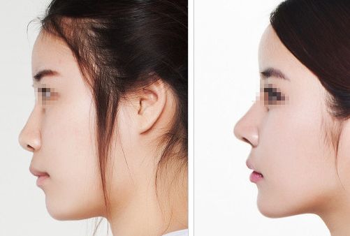 汕頭名流整形醫(yī)院：拉雙眼皮、吸脂價格一覽，專家解讀真實案例