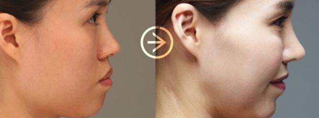 拯救發(fā)際線！如何自測(cè)發(fā)際線高度？