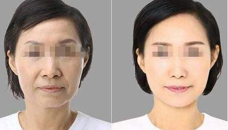 寧波玻尿酸去法令紋效果評(píng)價(jià)一覽