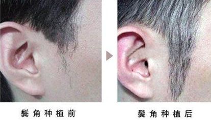 開眼角手術(shù)改善眼型，揭秘適合人群