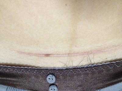 內(nèi)蒙古吸脂瘦身腹醫(yī)生