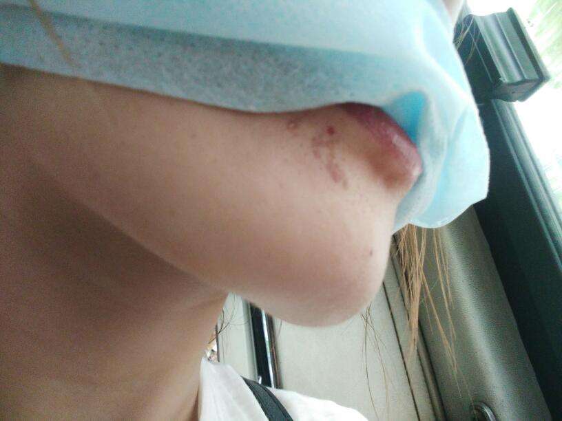 河北鐳射激光開(kāi)眼角醫(yī)生