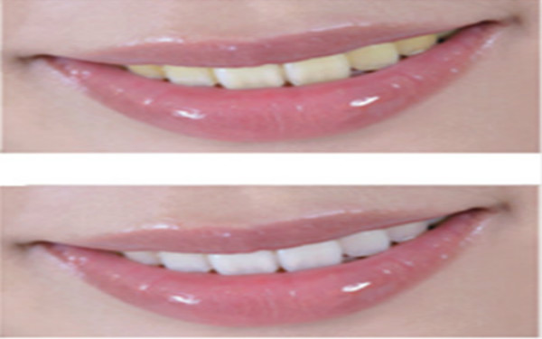 德陽面部射頻溶脂醫(yī)生