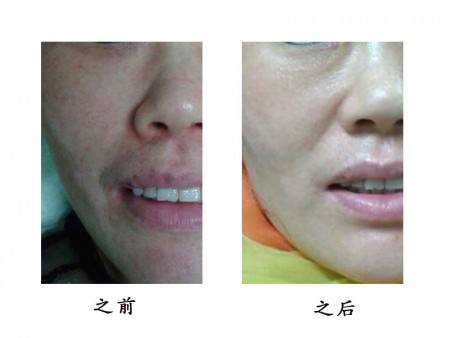 德陽(yáng)韓式假體隆胸手術(shù)醫(yī)生