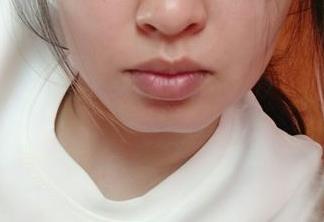 重慶祛斑皮秒醫(yī)生