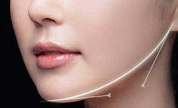 杭州法令紋注射填充醫(yī)生