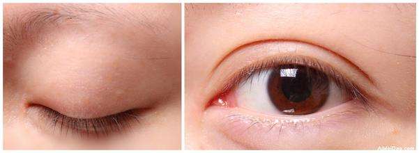 昆明隔空溶脂瘦肩部醫(yī)生