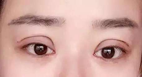 寧波提拉眼睛細紋醫(yī)生