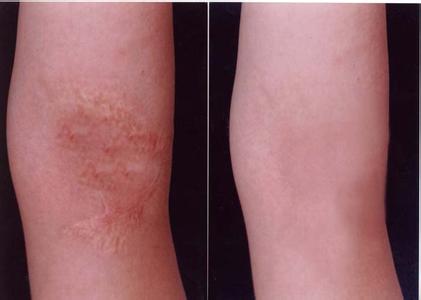 武漢淡化眼睛細紋醫(yī)生