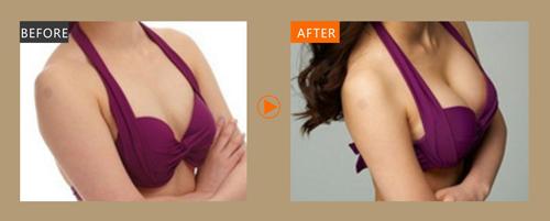 西安炫耀豐胸醫(yī)生