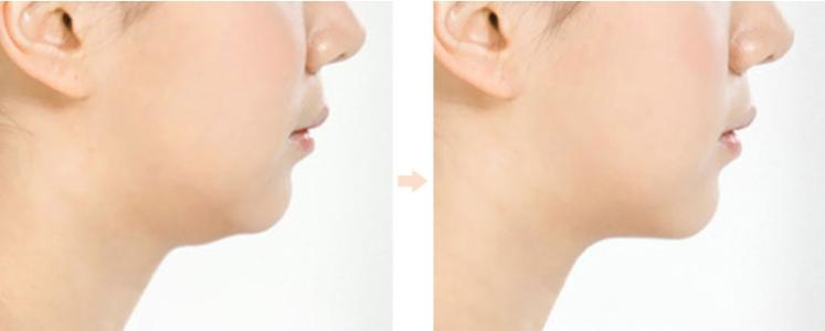 深圳面部填充面部皺紋醫(yī)生