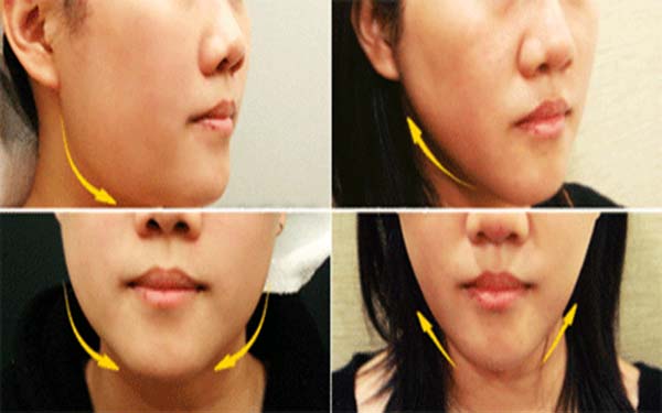 石家莊動態(tài)細紋注射填充醫(yī)生