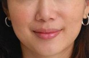 昆明射頻去眼底紋醫(yī)生