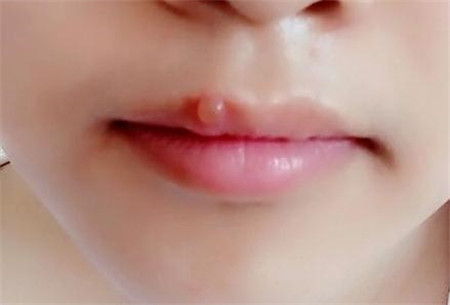 三亞光波去黑痣醫(yī)生