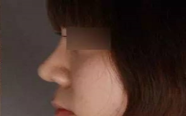 2023年匯總廣東地區(qū)三甲醫(yī)院雙眼皮手術(shù)排名TOP6