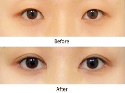 鄭州改善臉部松弛醫(yī)生