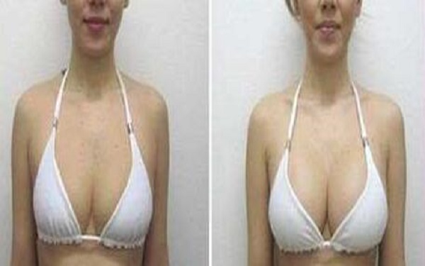 東莞最佳度膨體隆鼻醫(yī)院匯總：華美、維多利亞、禾美、知美脫穎而出！讓你一探究竟！