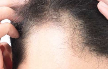 【溫州整形醫(yī)院】哪種埋線雙眼皮更適合？芘麗芙與伯思立對比及過來人經(jīng)驗分享