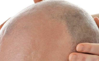 華美醫(yī)院榮登山東菏澤祛疤第一名，絕佳口碑再次奪冠！