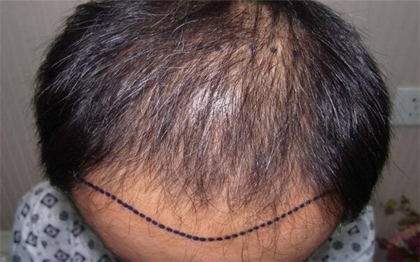 內蒙古烏蘭浩特市最佳修復雙眼皮技術，誠意推薦的專業(yè)醫(yī)療機構排行榜