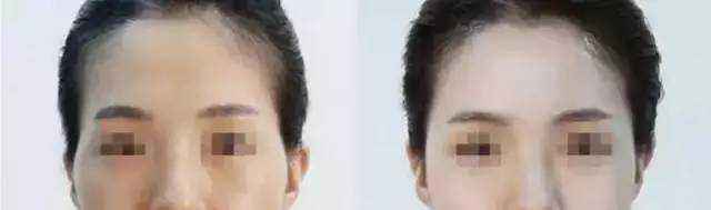 蘭州頂級整容醫(yī)院排行榜：讓你安心整形，保障你的雙眼皮手術(shù)結(jié)果！