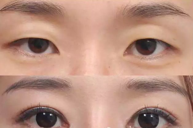 晉中韓式唯美豐胸醫(yī)生