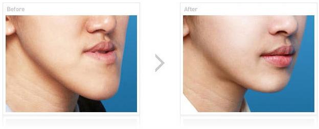 嘉興市最佳雙眼皮醫(yī)院評選揭曉！網(wǎng)友留言熱議翻墻！