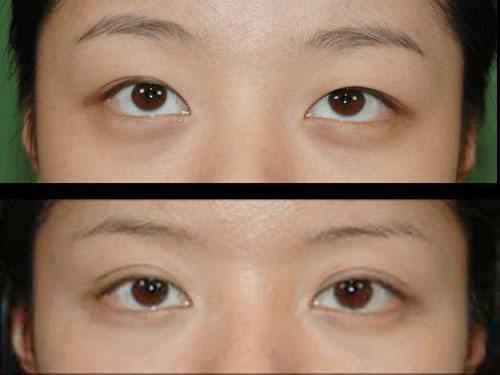 武漢冷凍法酒糟鼻治療醫(yī)生