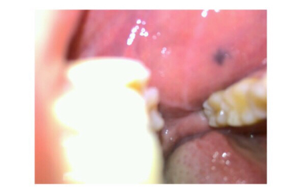 昆明重度鼻翼缺損修復(fù)醫(yī)生