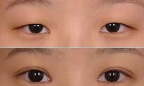 武漢玻尿酸注射隆鼻梁醫(yī)生