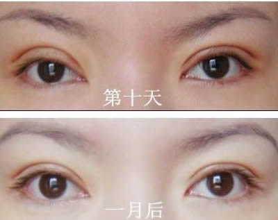 金華大拉皮去皺紋醫(yī)生