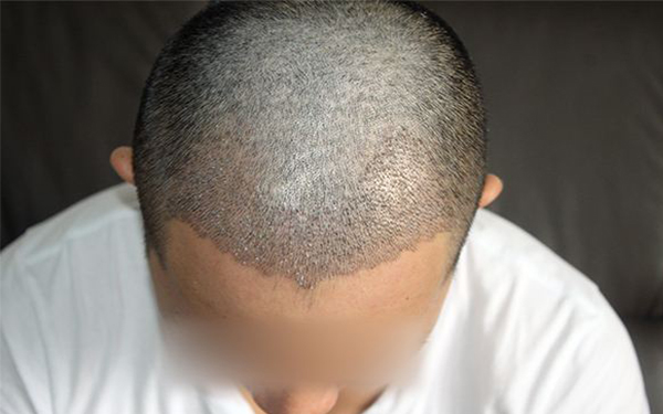 昆明脂肪填充整形醫(yī)院推薦！揭秘昆明四家專業(yè)醫(yī)美機(jī)構(gòu)，必看！