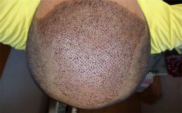 權(quán)威匯總！揭秘?fù)P州整形醫(yī)院眼袋切除頂尖技術(shù)