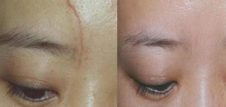 西寧去除額頭紋醫(yī)生