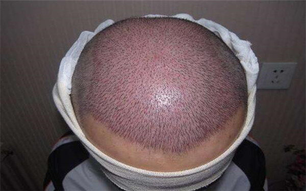 深圳祛除黑眼圈的五家整形醫(yī)院排名單公布！風格多樣，技術獨特！價目表內幕，助你選對醫(yī)院！