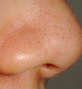 重慶填充動態(tài)細紋凹陷醫(yī)生