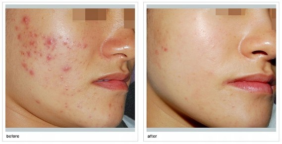 煙臺2023年最受青睞的割雙眼皮醫(yī)院：壹美天成、鵬愛、洛神、青韓、知顏排名TOP！